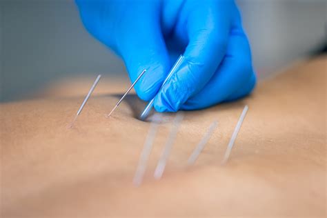 Acupuncture & Dry Needling .
